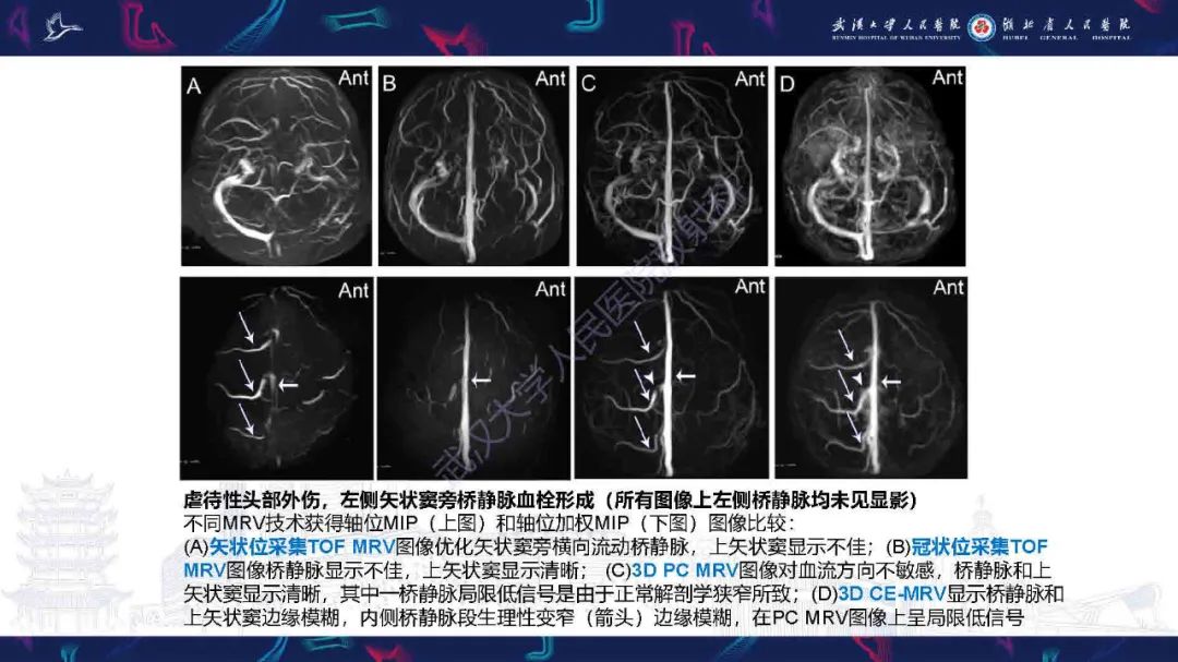 影像PPT - 【PPT】儿童脑静脉病变影像诊断-30