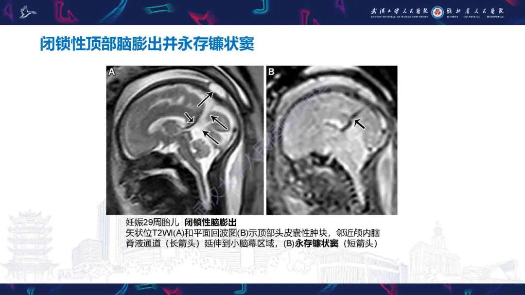 影像PPT - 【PPT】儿童脑静脉病变影像诊断-35