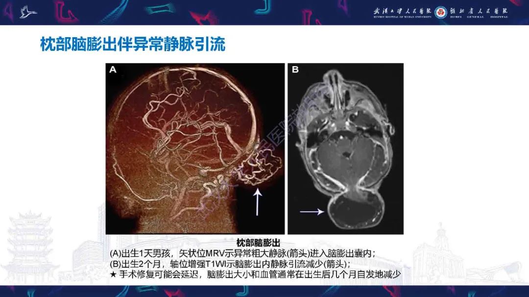 影像PPT - 【PPT】儿童脑静脉病变影像诊断-36
