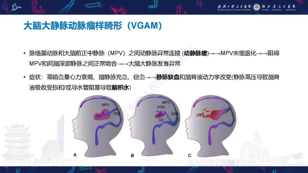 影像PPT - 【PPT】儿童脑静脉病变影像诊断-37