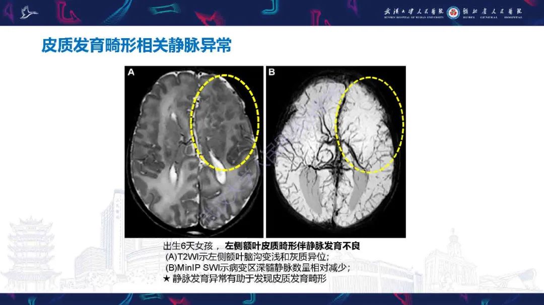 影像PPT - 【PPT】儿童脑静脉病变影像诊断-39