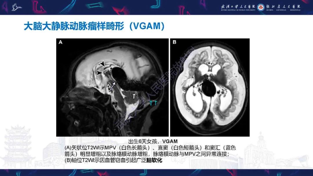 影像PPT - 【PPT】儿童脑静脉病变影像诊断-38