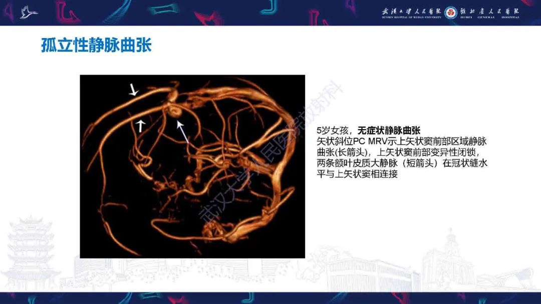 影像PPT - 【PPT】儿童脑静脉病变影像诊断-42