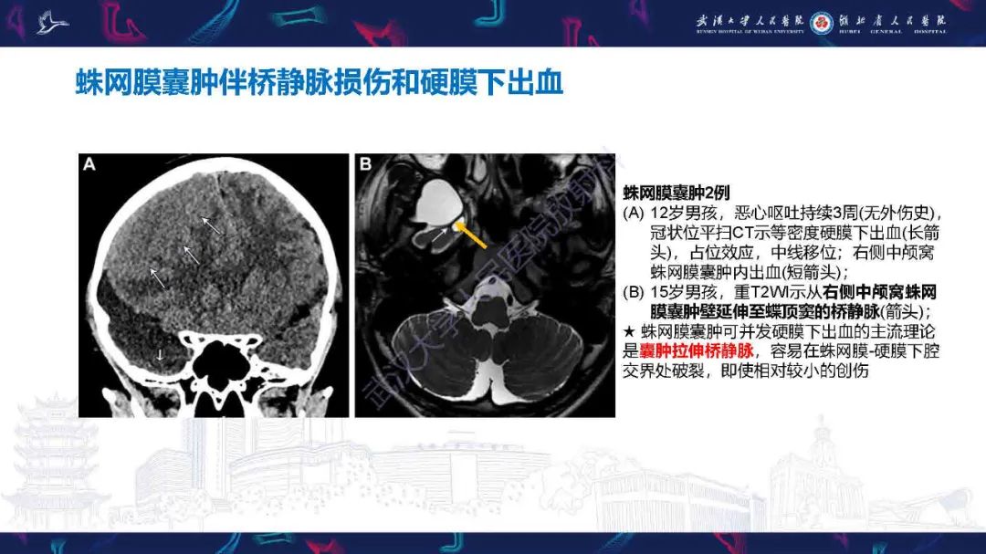 影像PPT - 【PPT】儿童脑静脉病变影像诊断-41
