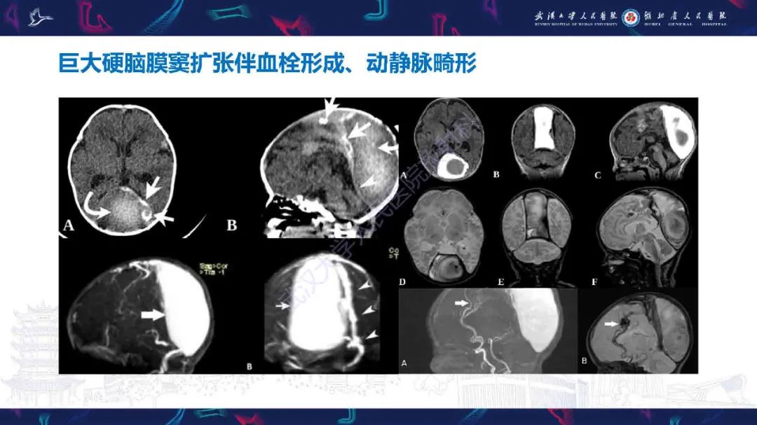 影像PPT - 【PPT】儿童脑静脉病变影像诊断-44