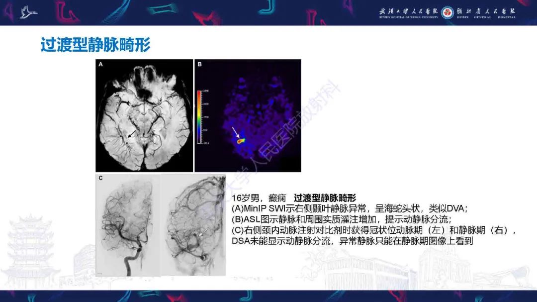 影像PPT - 【PPT】儿童脑静脉病变影像诊断-48