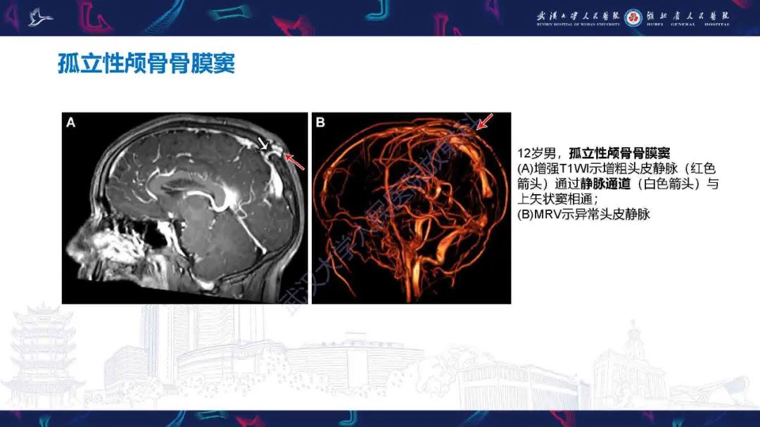影像PPT - 【PPT】儿童脑静脉病变影像诊断-50