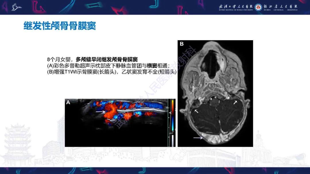 影像PPT - 【PPT】儿童脑静脉病变影像诊断-51