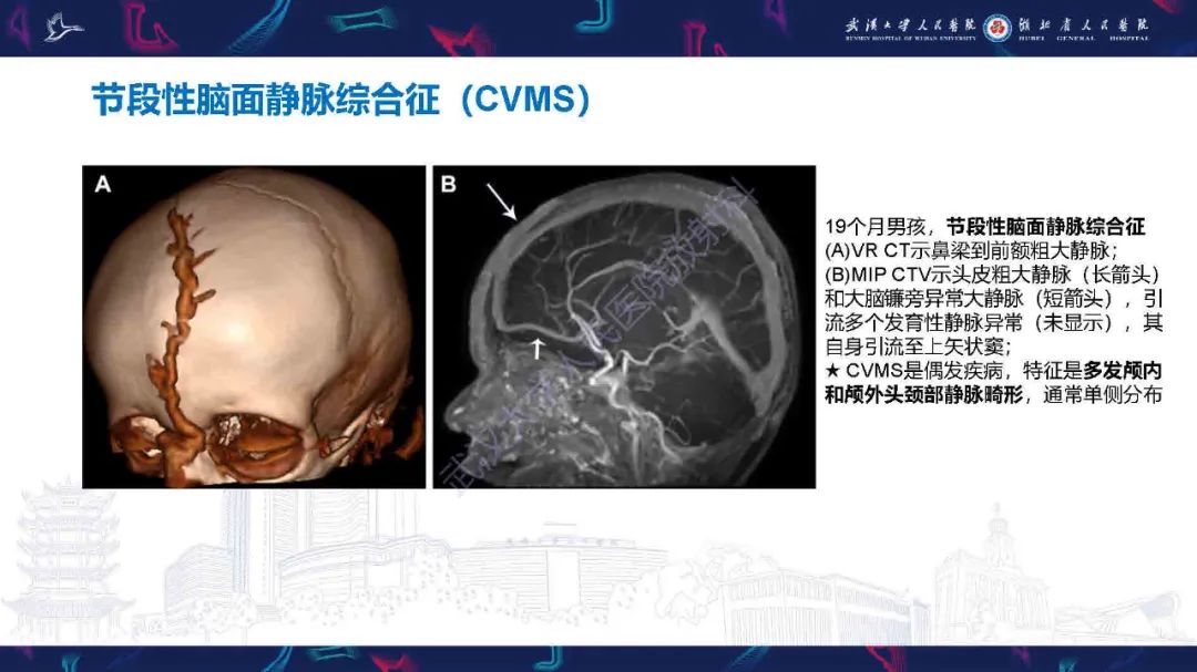 影像PPT - 【PPT】儿童脑静脉病变影像诊断-52