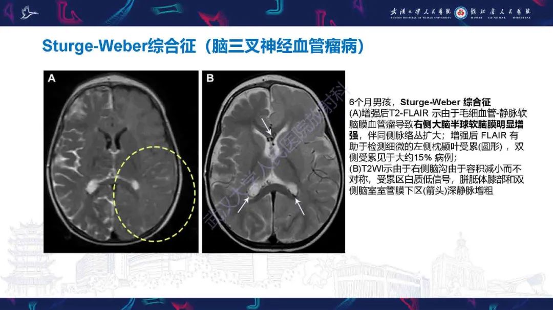 影像PPT - 【PPT】儿童脑静脉病变影像诊断-54