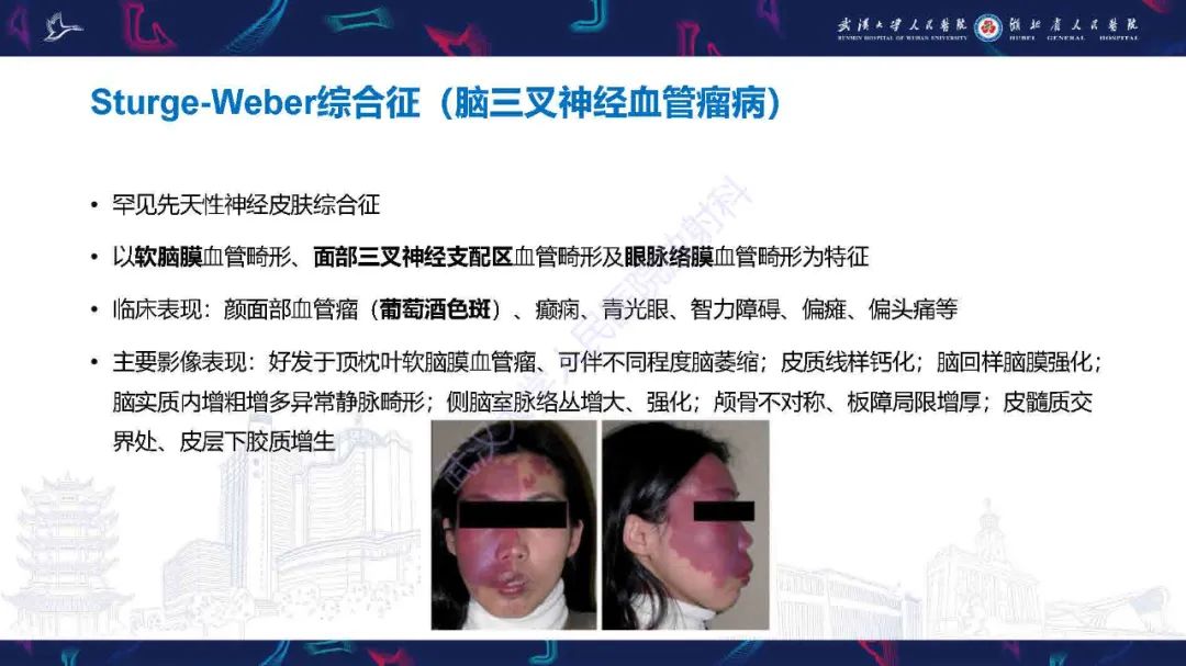 影像PPT - 【PPT】儿童脑静脉病变影像诊断-53