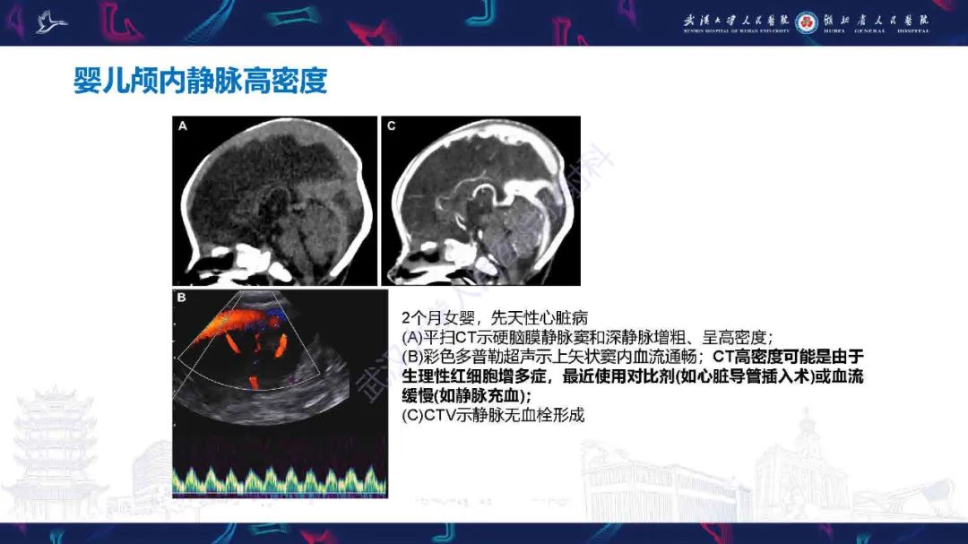 影像PPT - 【PPT】儿童脑静脉病变影像诊断-55