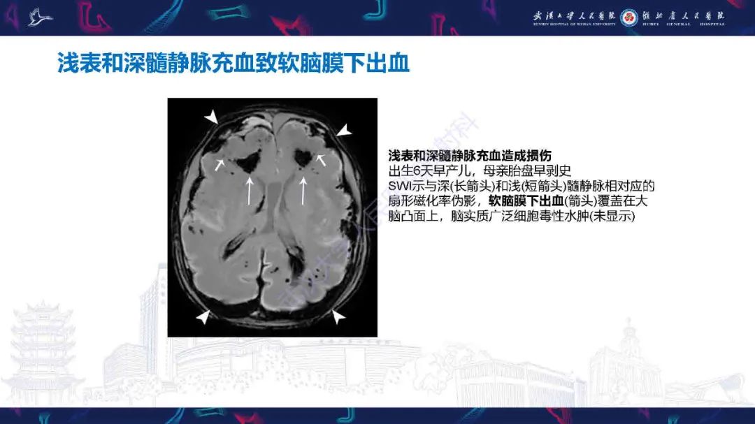 影像PPT - 【PPT】儿童脑静脉病变影像诊断-56