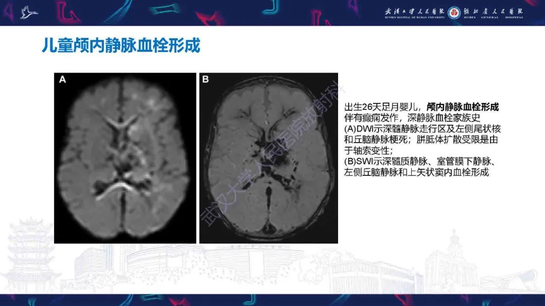影像PPT - 【PPT】儿童脑静脉病变影像诊断-57