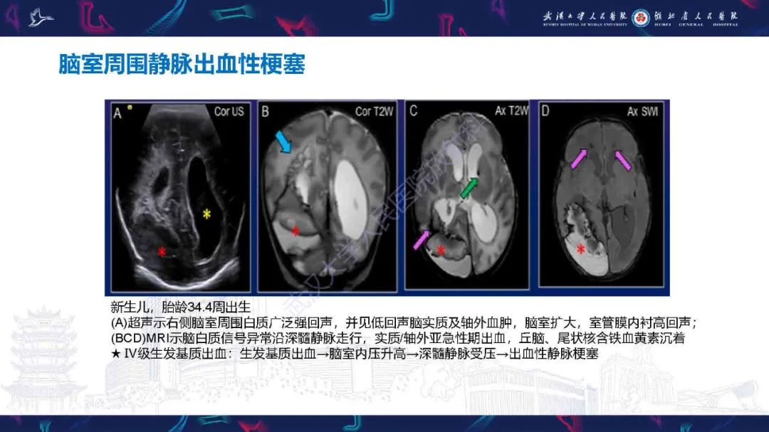 影像PPT - 【PPT】儿童脑静脉病变影像诊断-58