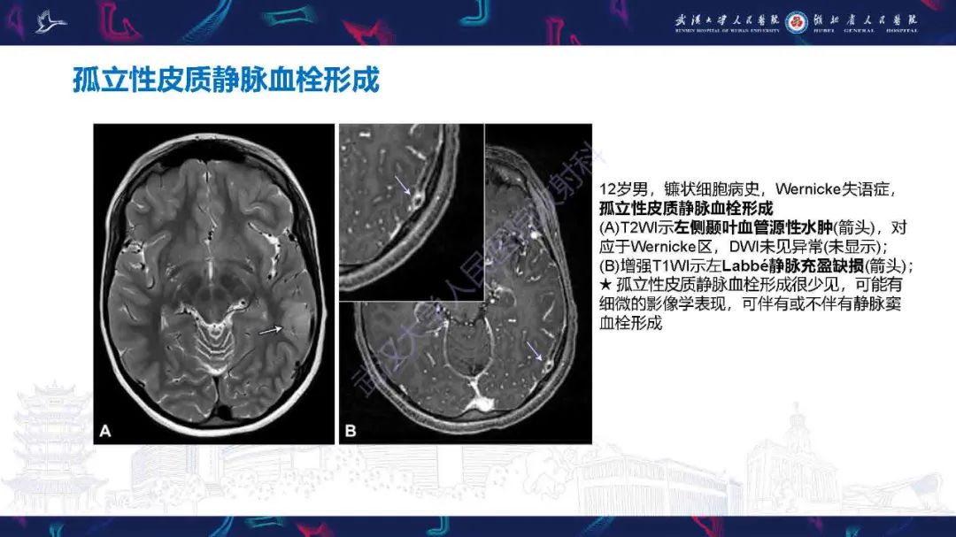 影像PPT - 【PPT】儿童脑静脉病变影像诊断-59