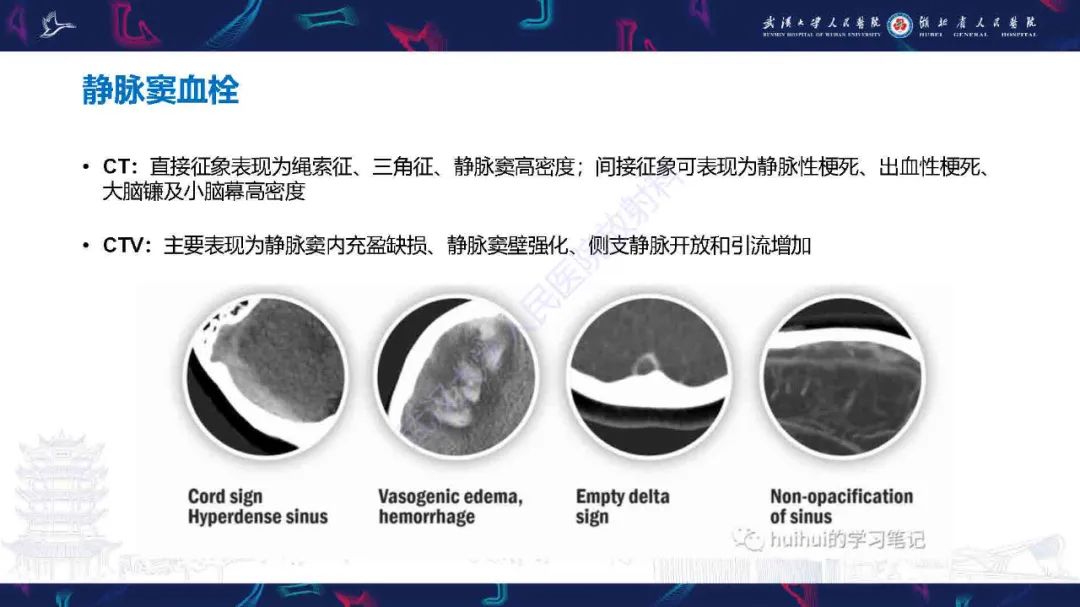 影像PPT - 【PPT】儿童脑静脉病变影像诊断-60