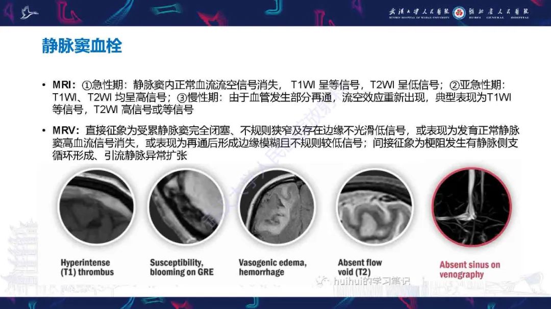 影像PPT - 【PPT】儿童脑静脉病变影像诊断-61