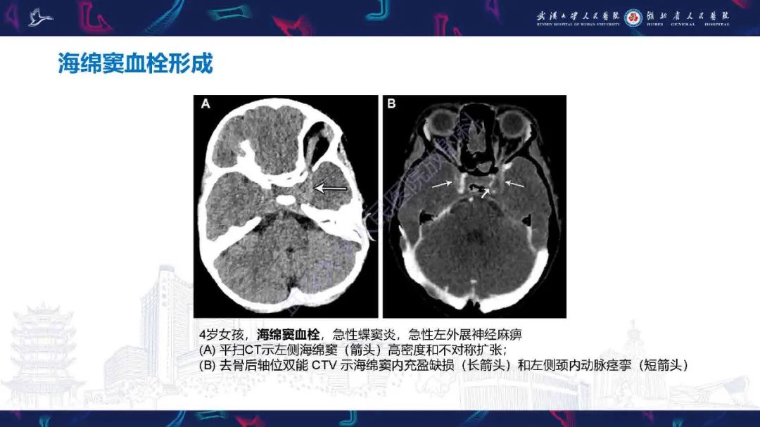 影像PPT - 【PPT】儿童脑静脉病变影像诊断-62