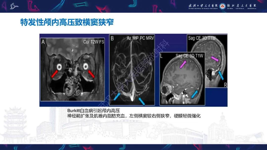 影像PPT - 【PPT】儿童脑静脉病变影像诊断-63