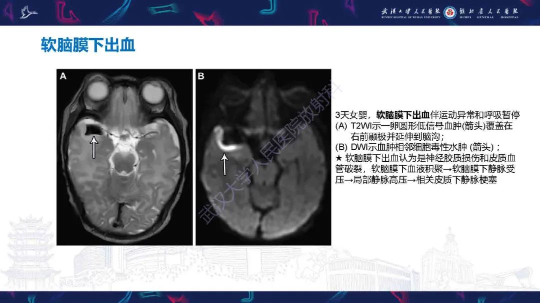 影像PPT - 【PPT】儿童脑静脉病变影像诊断-65