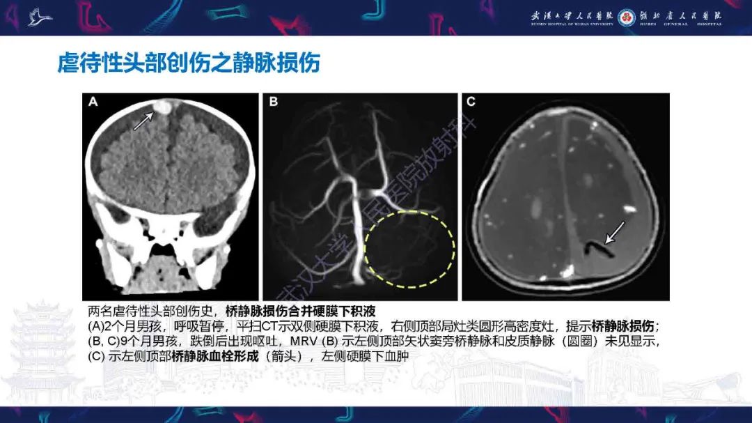 影像PPT - 【PPT】儿童脑静脉病变影像诊断-67