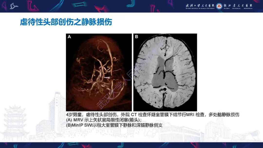 影像PPT - 【PPT】儿童脑静脉病变影像诊断-68