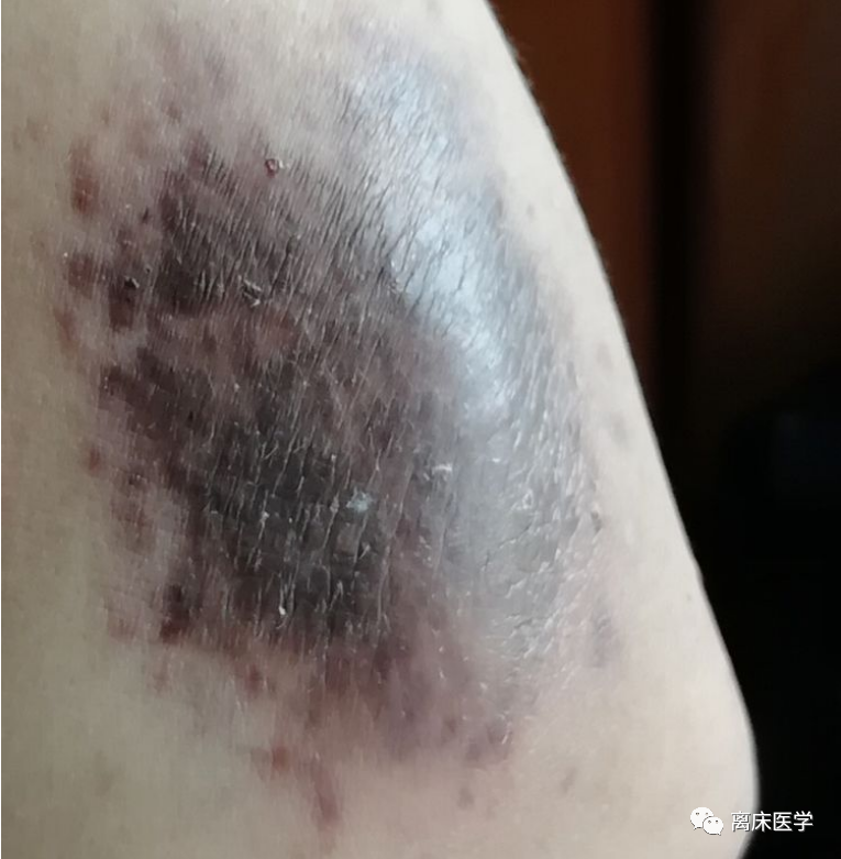 影像PPT - 【病例】肠套叠—卡波西肉瘤的罕见并发症-9 影像PPT - 【病例】肠套叠—卡波西肉瘤的罕见并发症-9