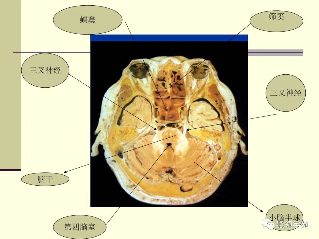 影像PPT - 三叉神经解剖及常见疾病MR表现-24