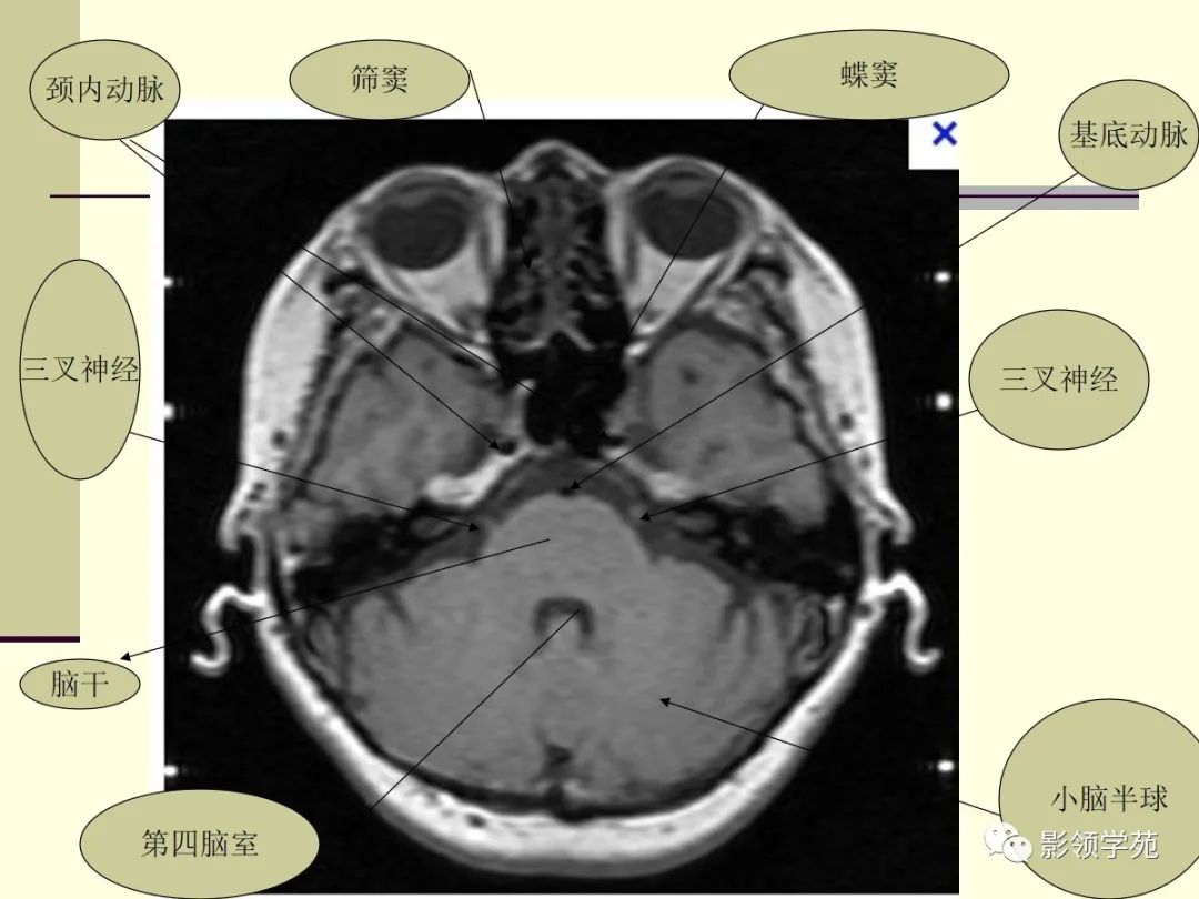 影像PPT - 三叉神经解剖及常见疾病MR表现-25