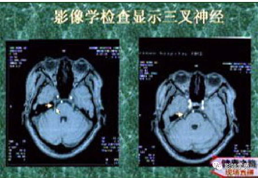 影像PPT - 三叉神经解剖及常见疾病MR表现-29