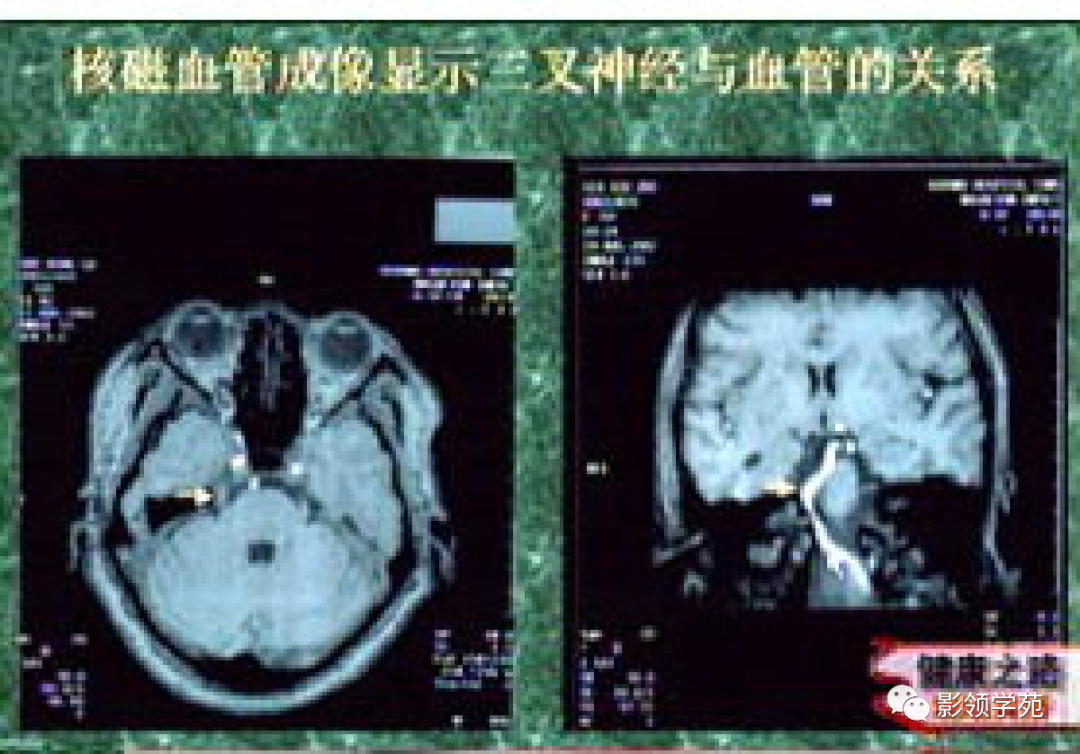 影像PPT - 三叉神经解剖及常见疾病MR表现-30