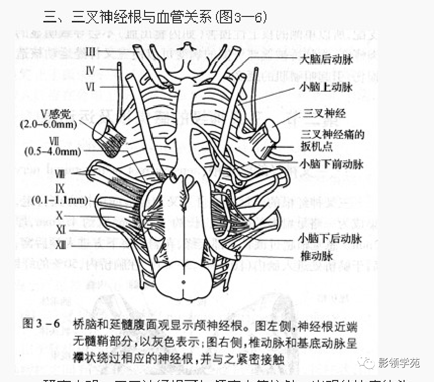 影像PPT - 三叉神经解剖及常见疾病MR表现-32