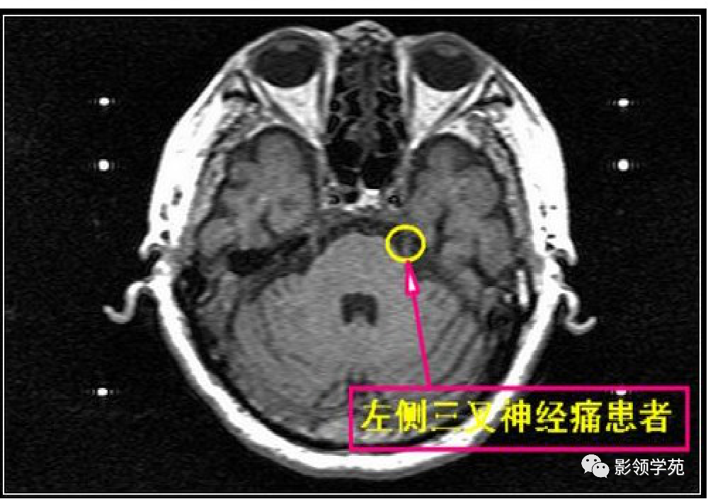 影像PPT - 三叉神经解剖及常见疾病MR表现-33