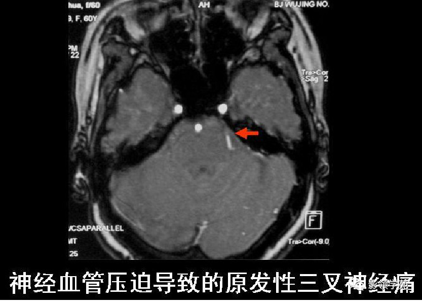 影像PPT - 三叉神经解剖及常见疾病MR表现-35