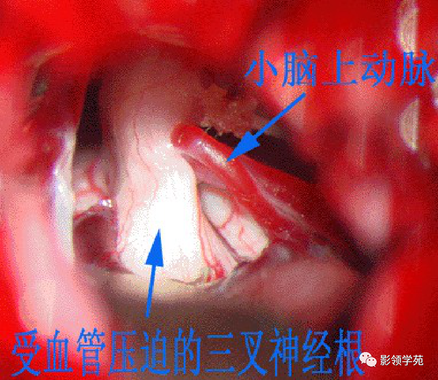 影像PPT - 三叉神经解剖及常见疾病MR表现-38