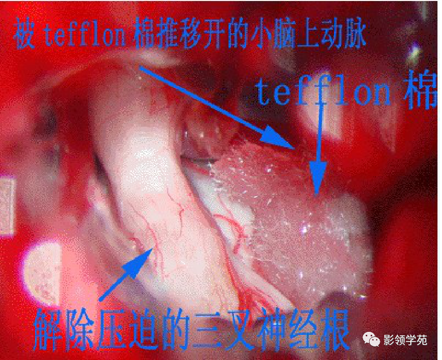 影像PPT - 三叉神经解剖及常见疾病MR表现-39