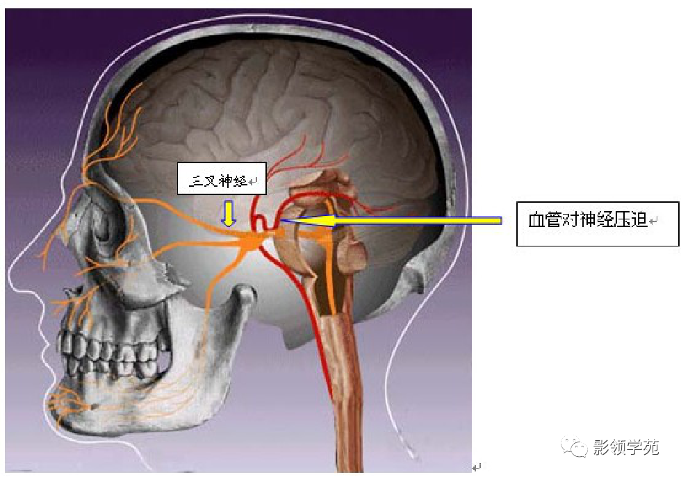 影像PPT - 三叉神经解剖及常见疾病MR表现-41