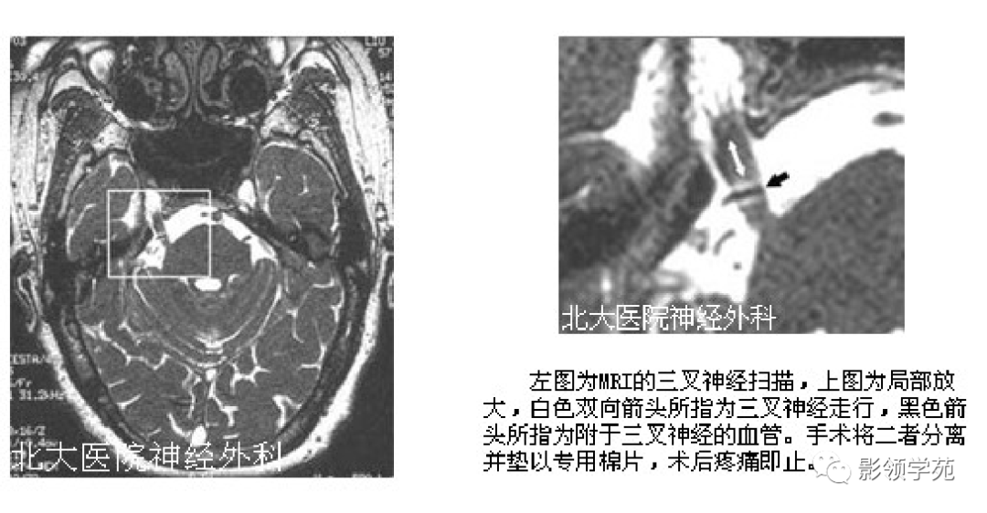 影像PPT - 三叉神经解剖及常见疾病MR表现-42