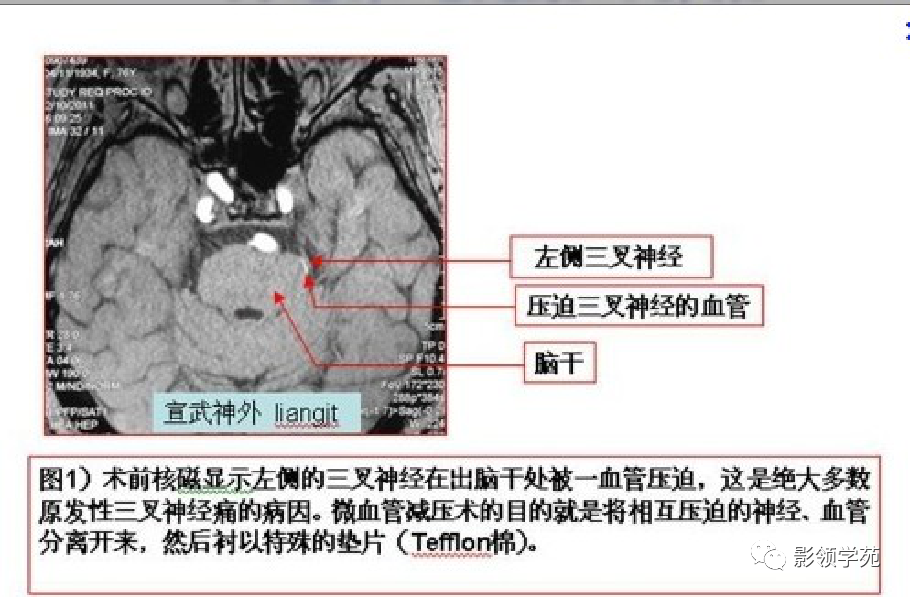 影像PPT - 三叉神经解剖及常见疾病MR表现-43