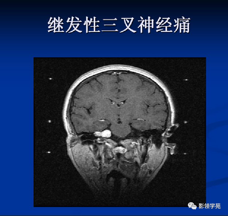 影像PPT - 三叉神经解剖及常见疾病MR表现-45