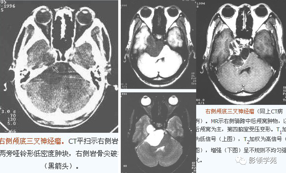 影像PPT - 三叉神经解剖及常见疾病MR表现-50