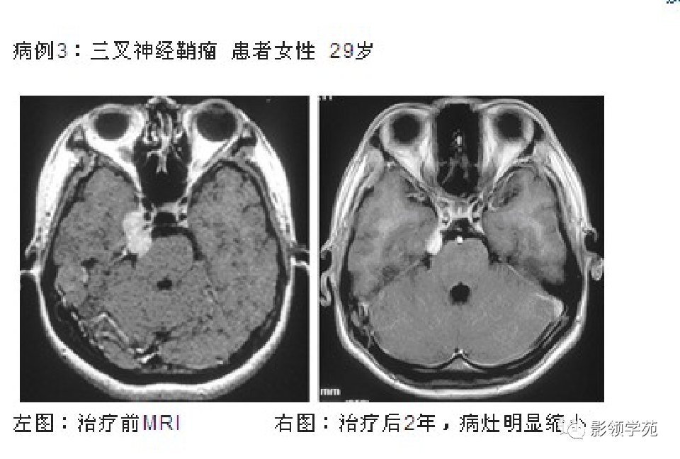影像PPT - 三叉神经解剖及常见疾病MR表现-51