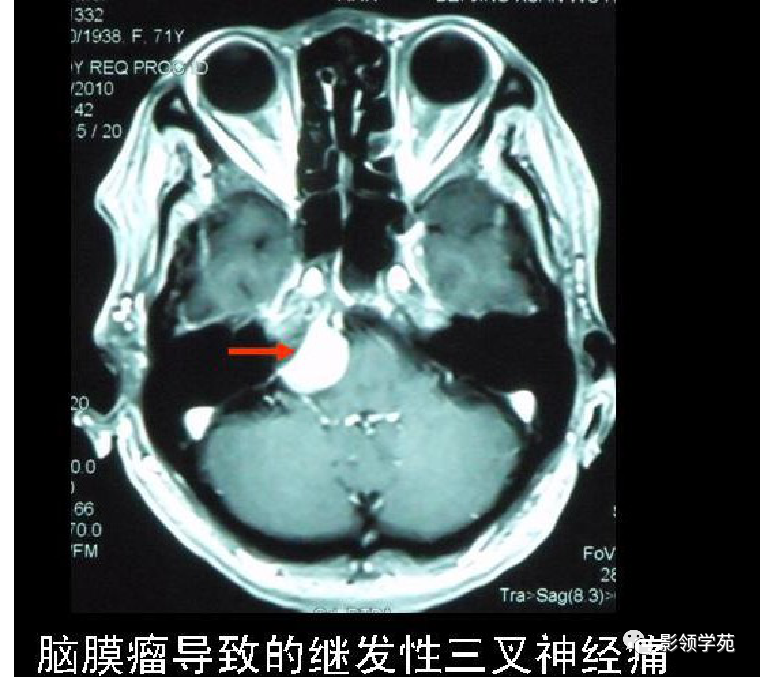 影像PPT - 三叉神经解剖及常见疾病MR表现-54