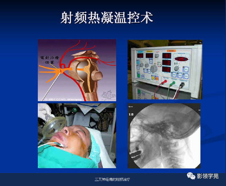 影像PPT - 三叉神经解剖及常见疾病MR表现-57