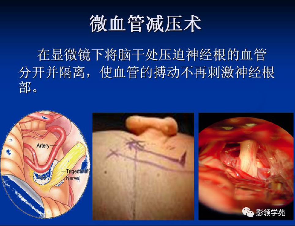 影像PPT - 三叉神经解剖及常见疾病MR表现-58