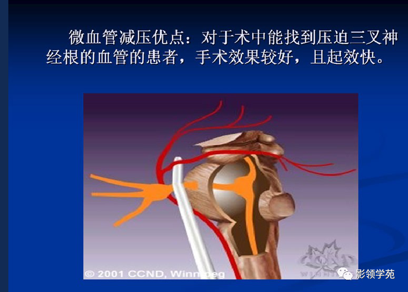 影像PPT - 三叉神经解剖及常见疾病MR表现-59
