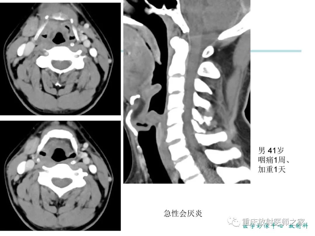 影像PPT - 【PPT】咽喉部病变影像分析-5