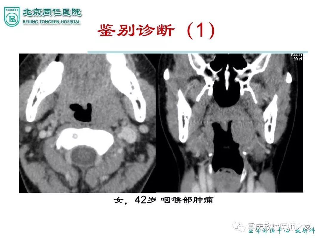 影像PPT - 【PPT】咽喉部病变影像分析-9