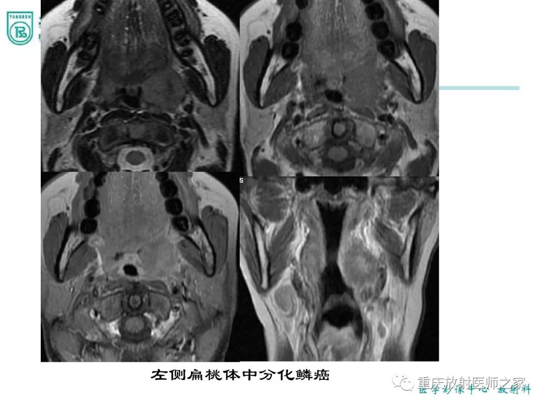 影像PPT - 【PPT】咽喉部病变影像分析-10